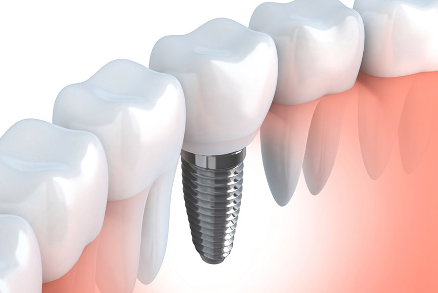 implantologia-dentale2